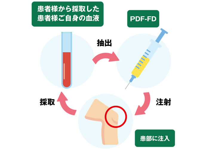 「PDF-FD療法」=“自分の血液を使った注射治療”という新たな選択肢